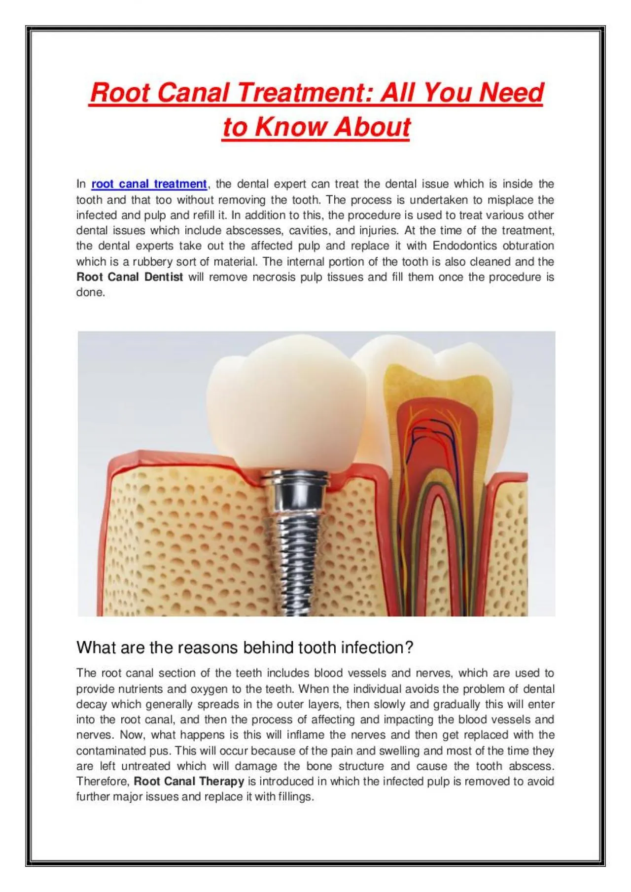 PDF-Root Canal Treatment: All You Need to Know About