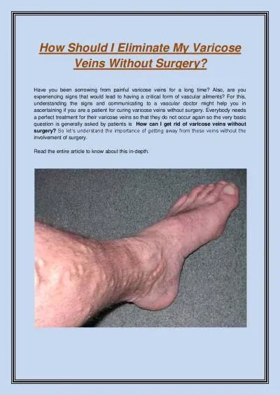 How Should I Eliminate My Varicose Veins Without Surgery?