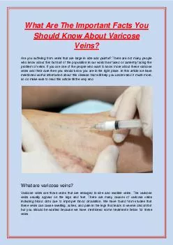What Are The Important Facts You Should Know About Varicose Veins?