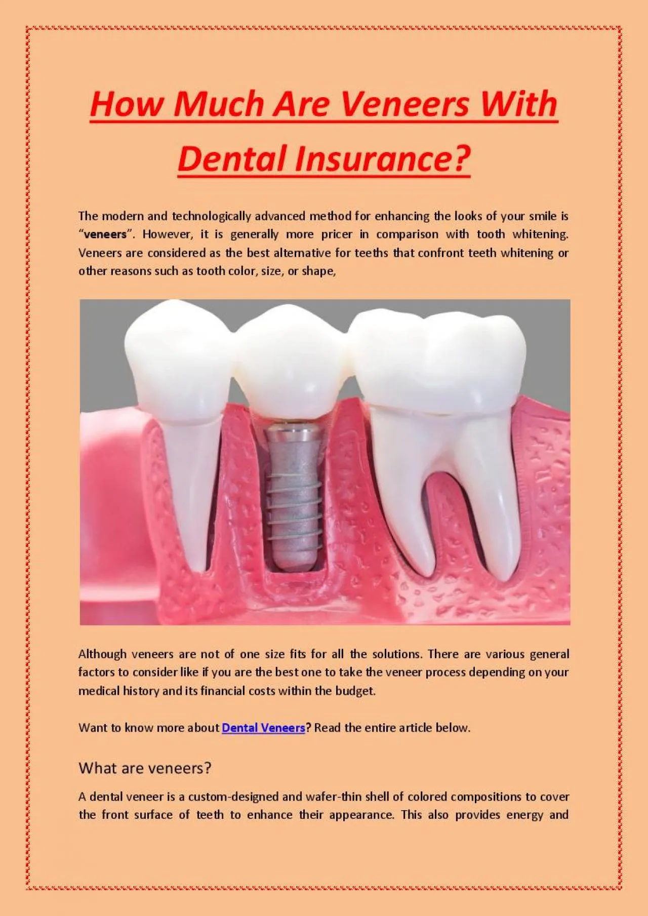 PDF-How Much Are Veneers With Dental Insurance?