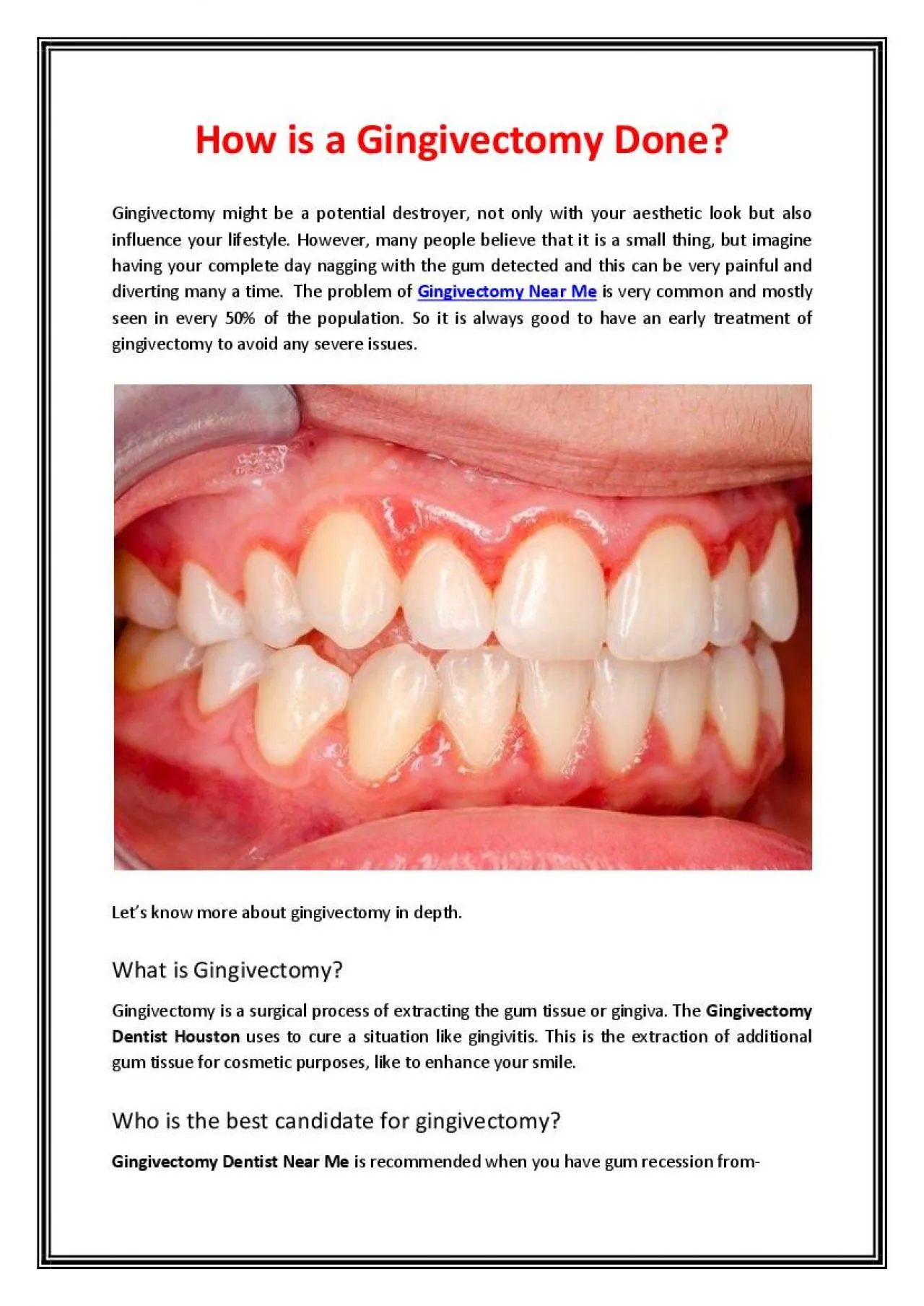 PDF-How is a Gingivectomy Done?