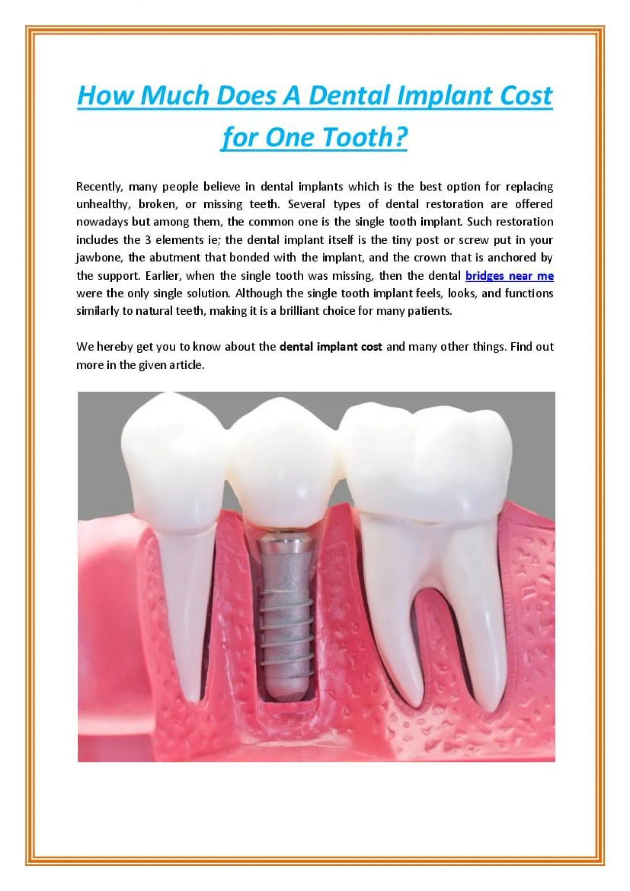 PDF-How Much Does A Dental Implant Cost for One Tooth?