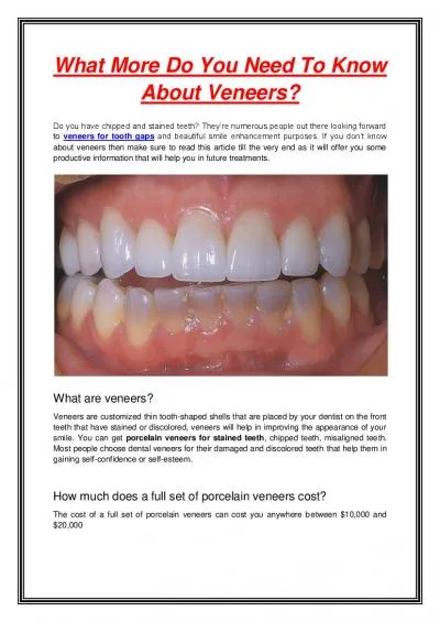 What More Do You Need To Know About Veneers?