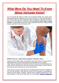 What More Do You Need To Know About Varicose Veins?