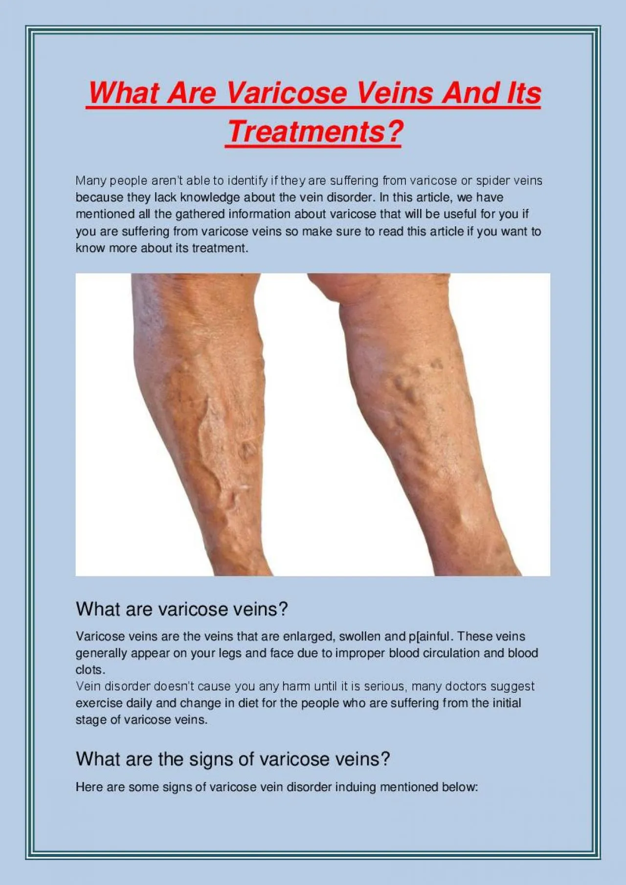 PDF-What Are Varicose Veins And Its Treatments?