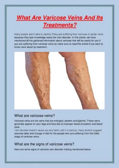 What Are Varicose Veins And Its Treatments?