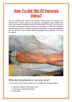 How To Get Rid Of Varicose Veins?