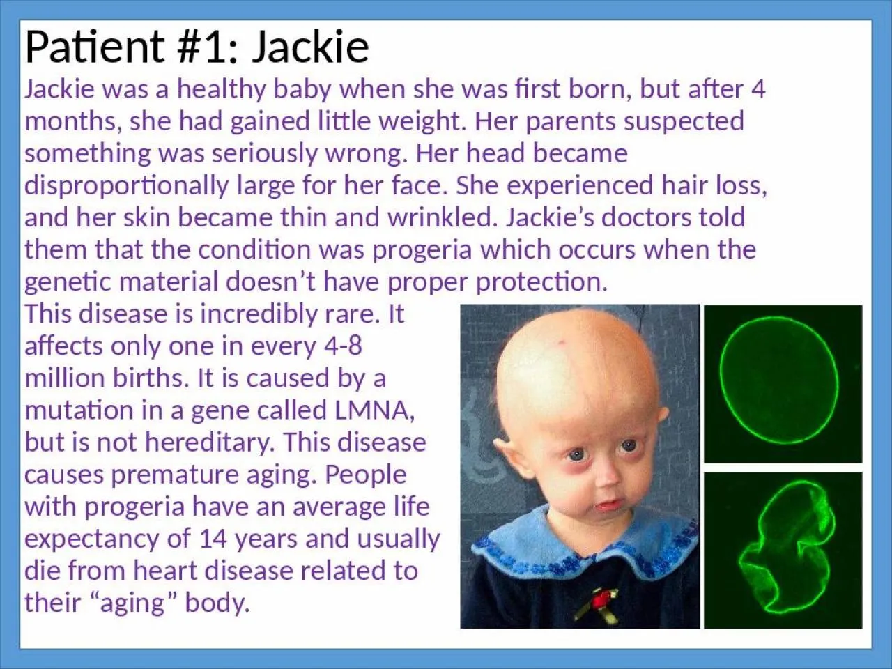 PPT-Patient #1: Jackie Jackie was a healthy baby when she was first born, but after 4 months,