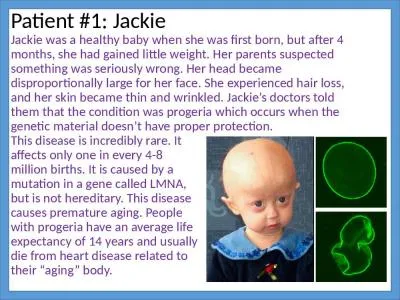 Patient #1: Jackie  Jackie was a healthy baby when she was first born, but after 4 months,