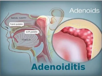 Adenoiditis  Definition