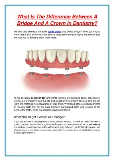 What Is The Difference Between A Bridge And A Crown In Dentistry?