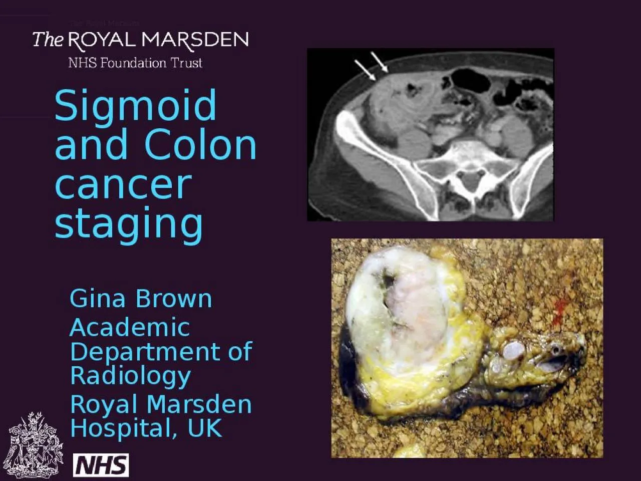 PPT-Sigmoid and Colon cancer staging