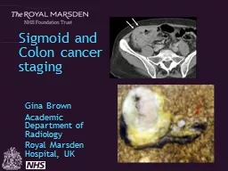 Sigmoid and Colon cancer staging