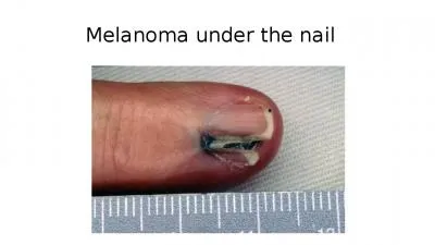 Melanoma   under   the