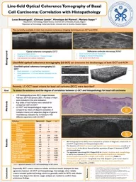 Line-field Optical Coherence Tomography of Basal Cell Carcinoma: Correlation with Histopathology
