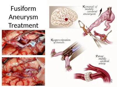 Fusiform  Aneurysm Treatment