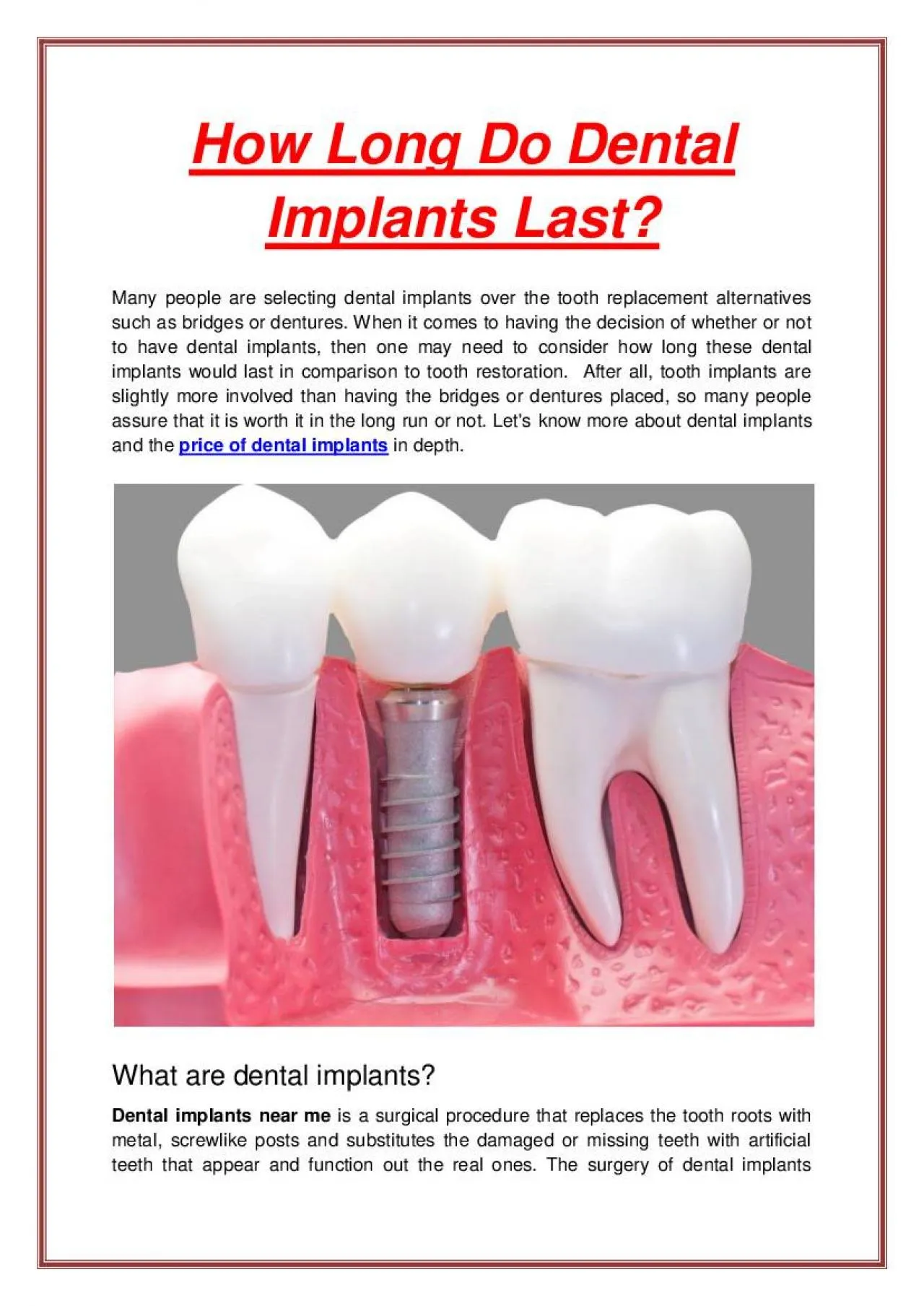 PDF-How Long Do Dental Implants Last?