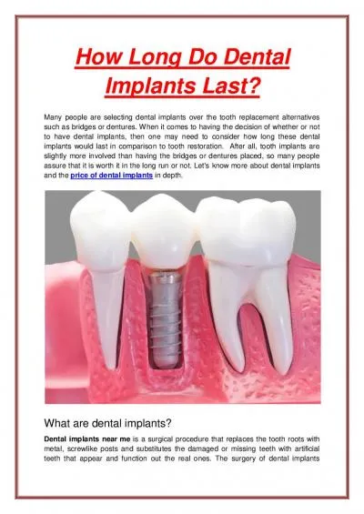 How Long Do Dental  Implants Last?