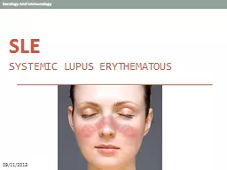 SLE  Systemic Lupus Erythematous