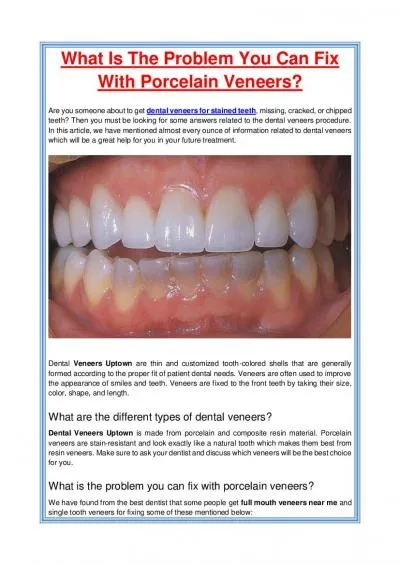 What Is The Problem You Can Fix With Porcelain Veneers?