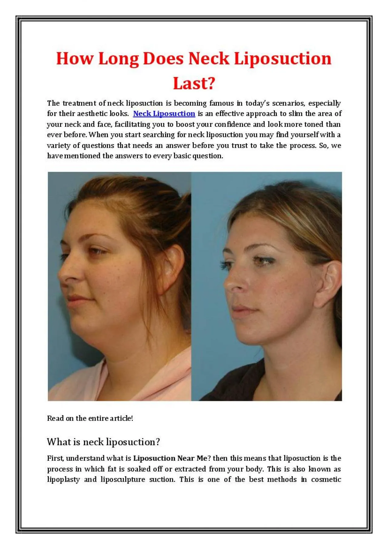 PDF-How Long Does Neck Liposuction Last?