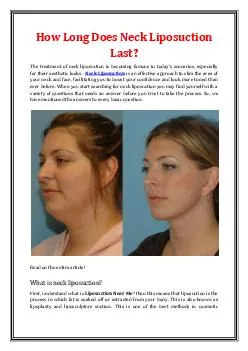 How Long Does Neck Liposuction Last?