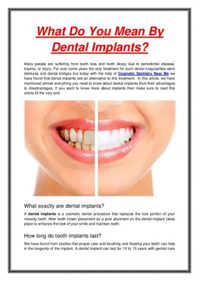 What Do You Mean By Dental Implants?