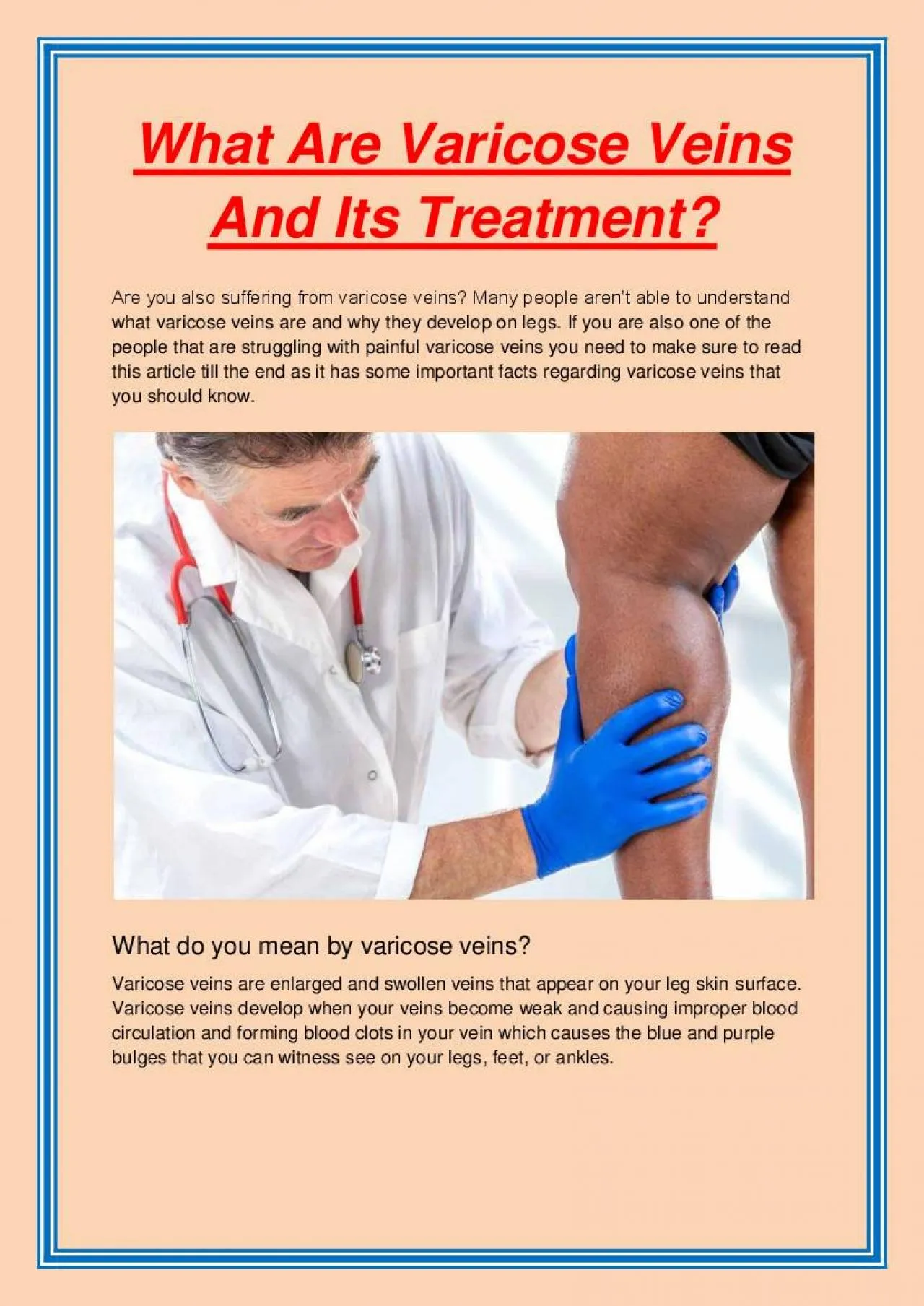 PDF-What Are Varicose Veins And Its Treatment?