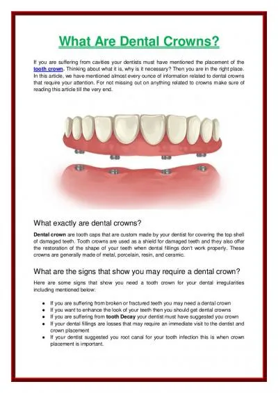 What Are Dental Crowns?