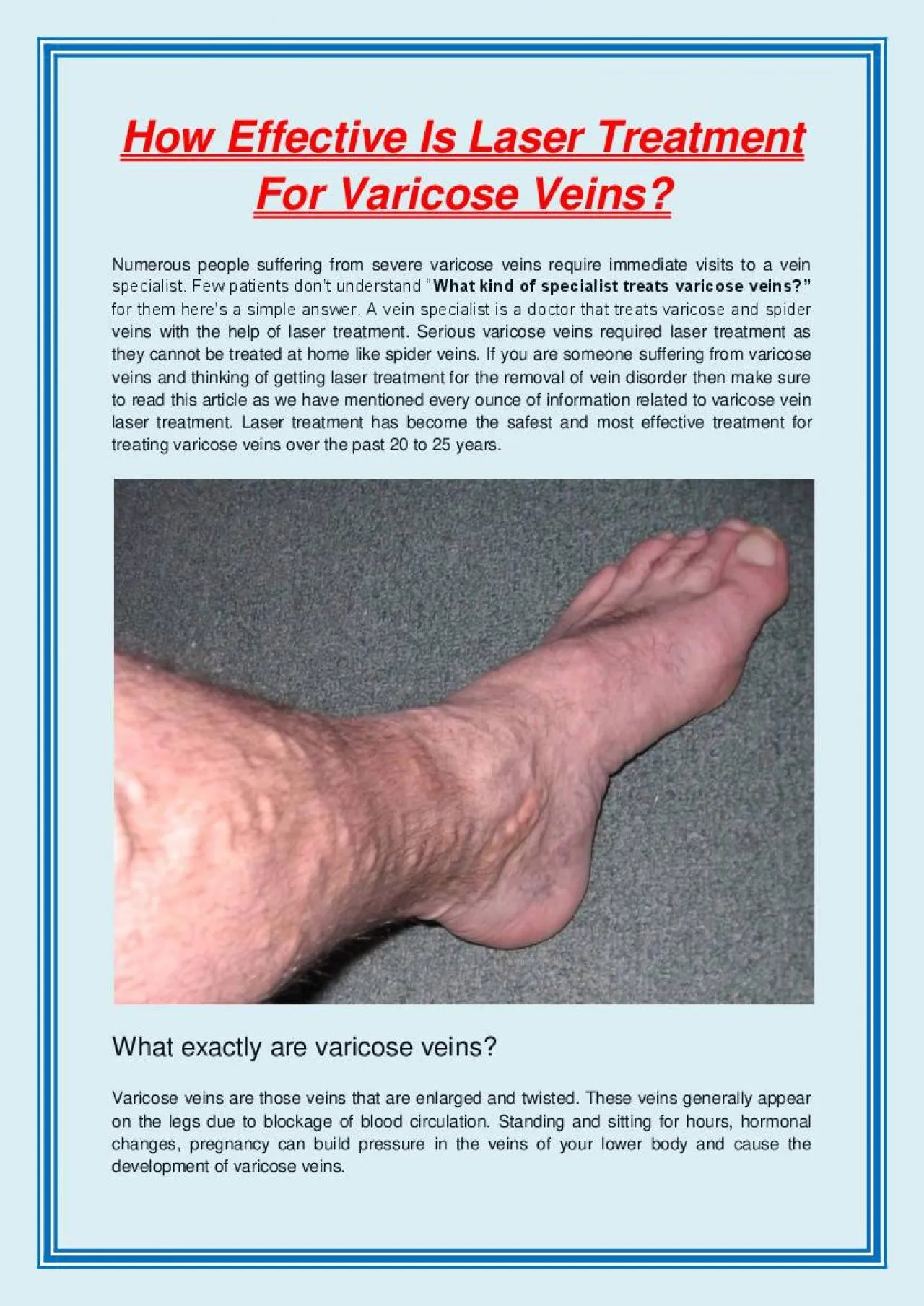 PDF-How Effective Is Laser Treatment For Varicose Veins?