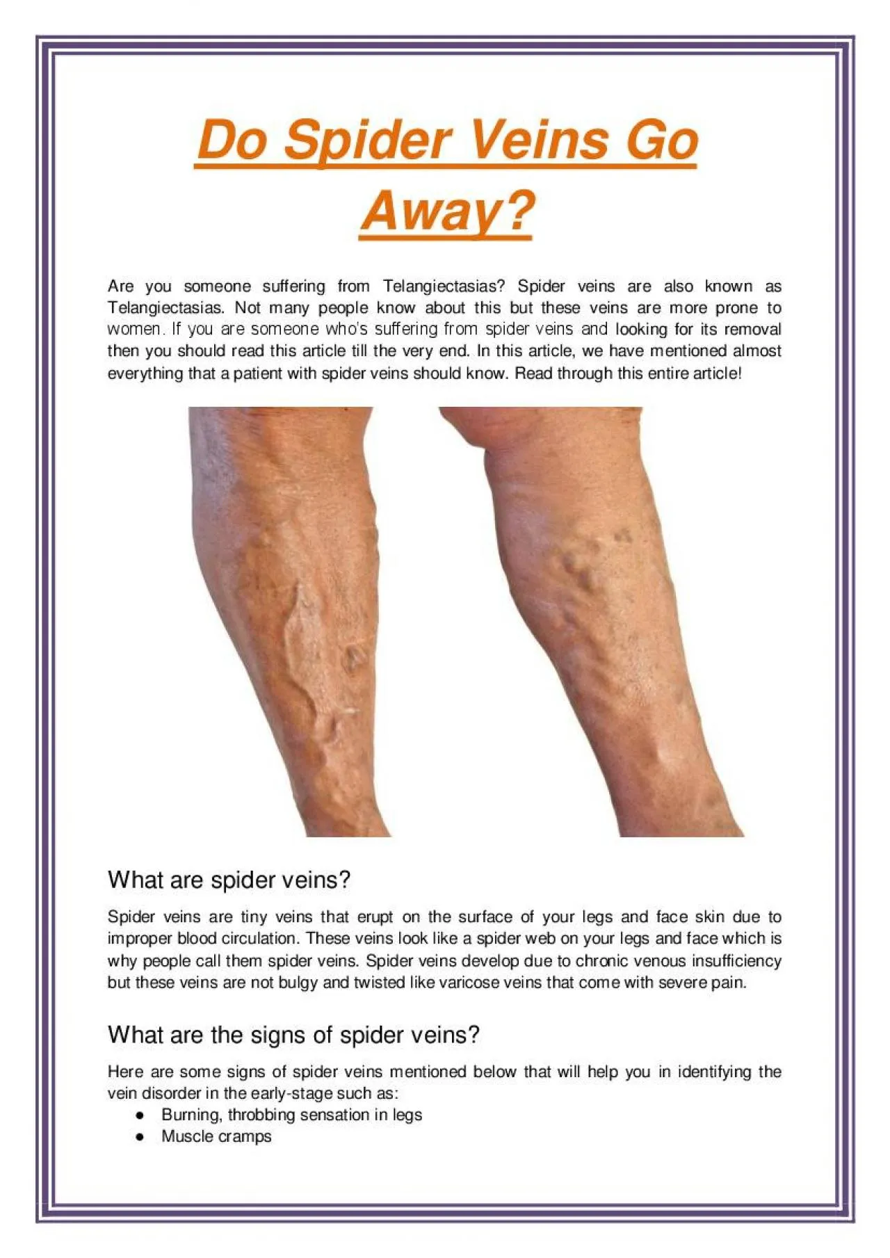 PDF-Do Spider Veins Go Away?