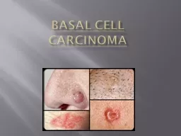 Basal Cell Carcinoma What is it?