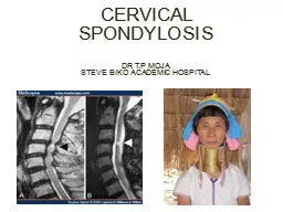 CERVICAL SPONDYLOSIS DR T.P MOJA