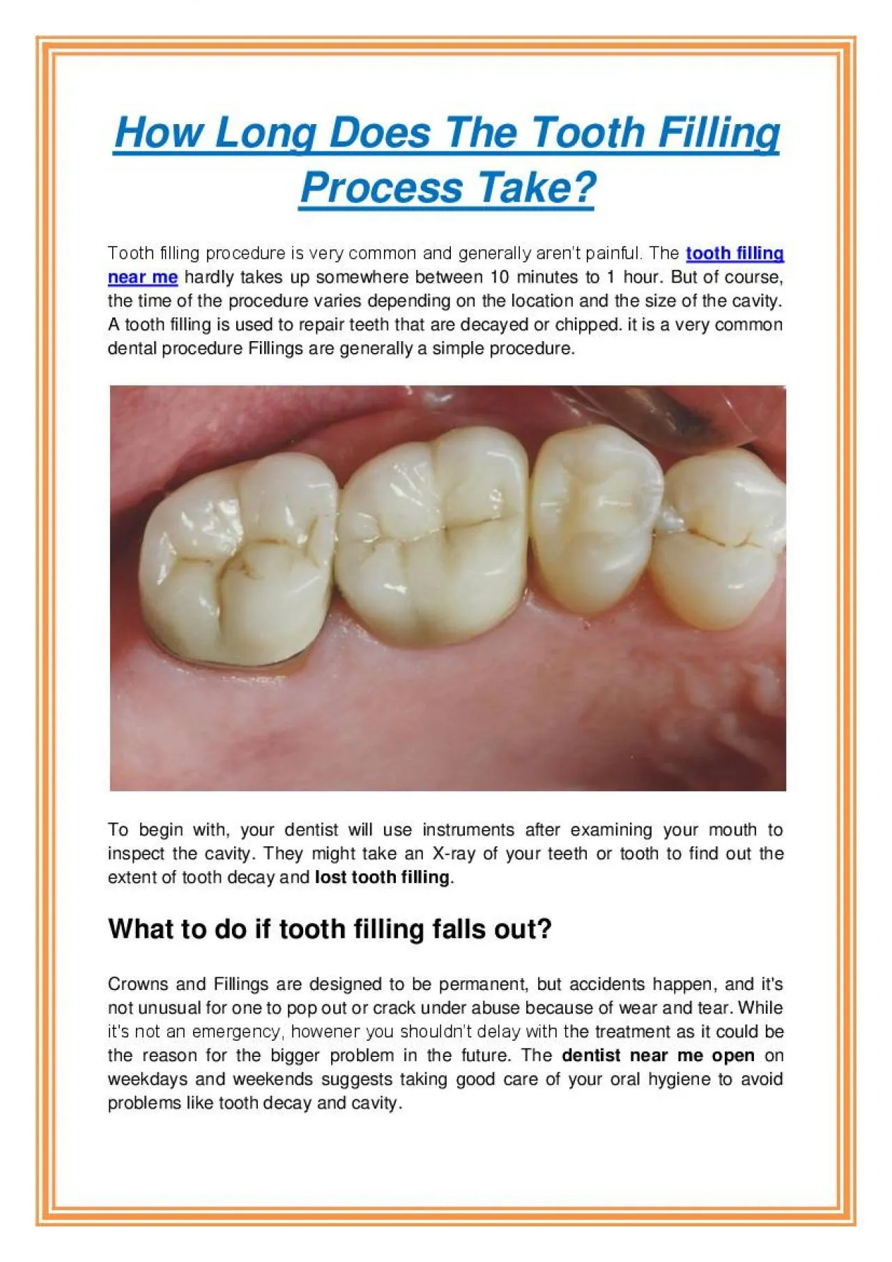 PDF-How Long Does The Tooth Filling Process Take?