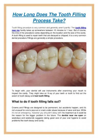 How Long Does The Tooth Filling Process Take?