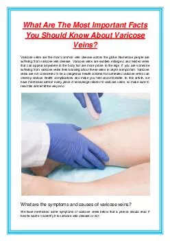 What Are The Most Important Facts You Should Know About Varicose Veins?