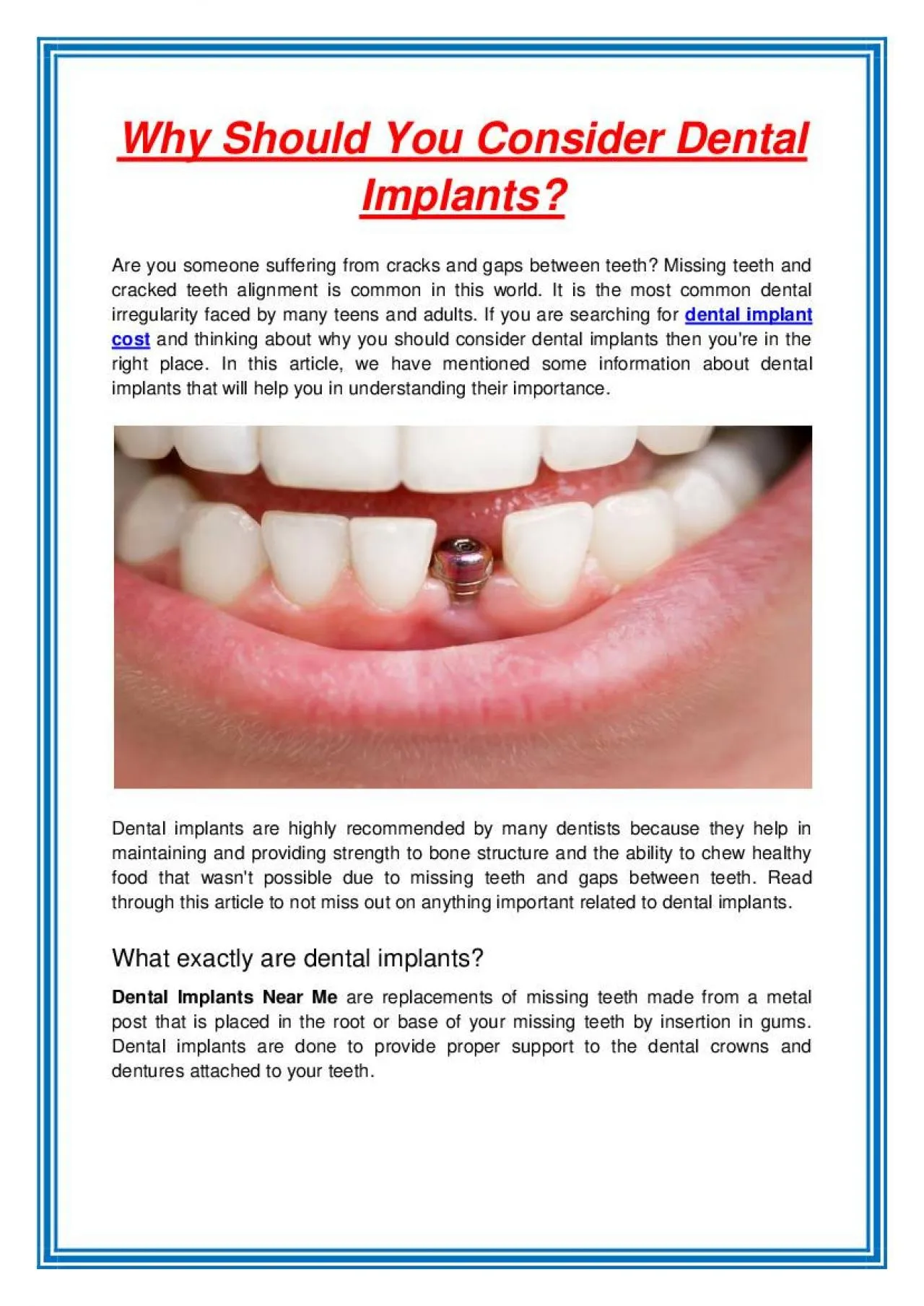 PDF-Why Should You Consider Dental Implants?