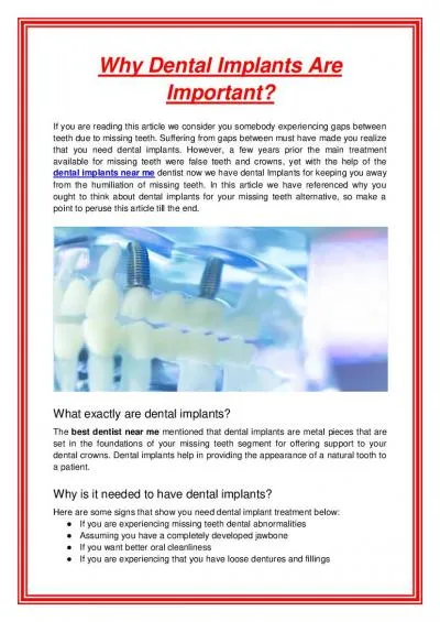 Why Dental Implants Are Important?