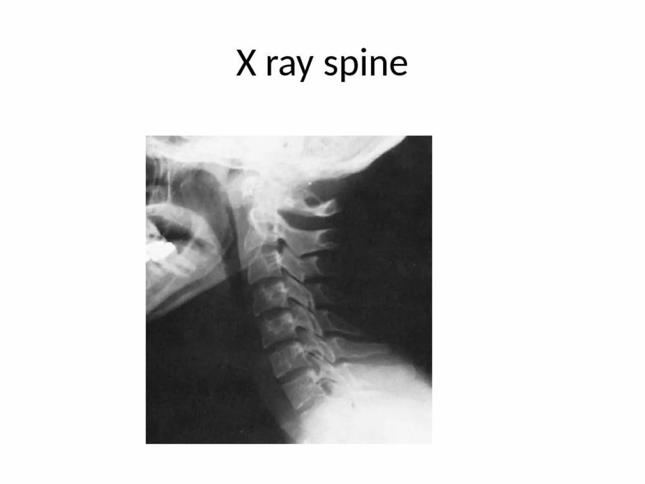 PPT-X ray spine SPINE TRAUMA