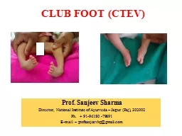 CLUB FOOT (CTEV) Prof. Sanjeev Sharma