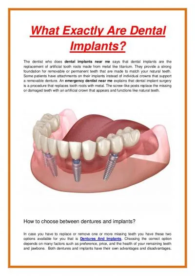 What Exactly Are Dental Implants?