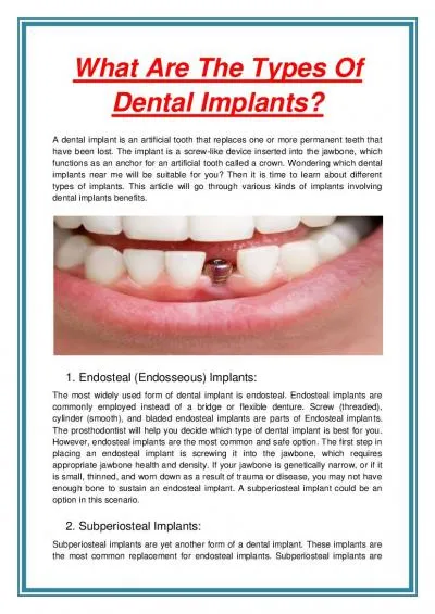 What Are The Types Of Dental Implants?