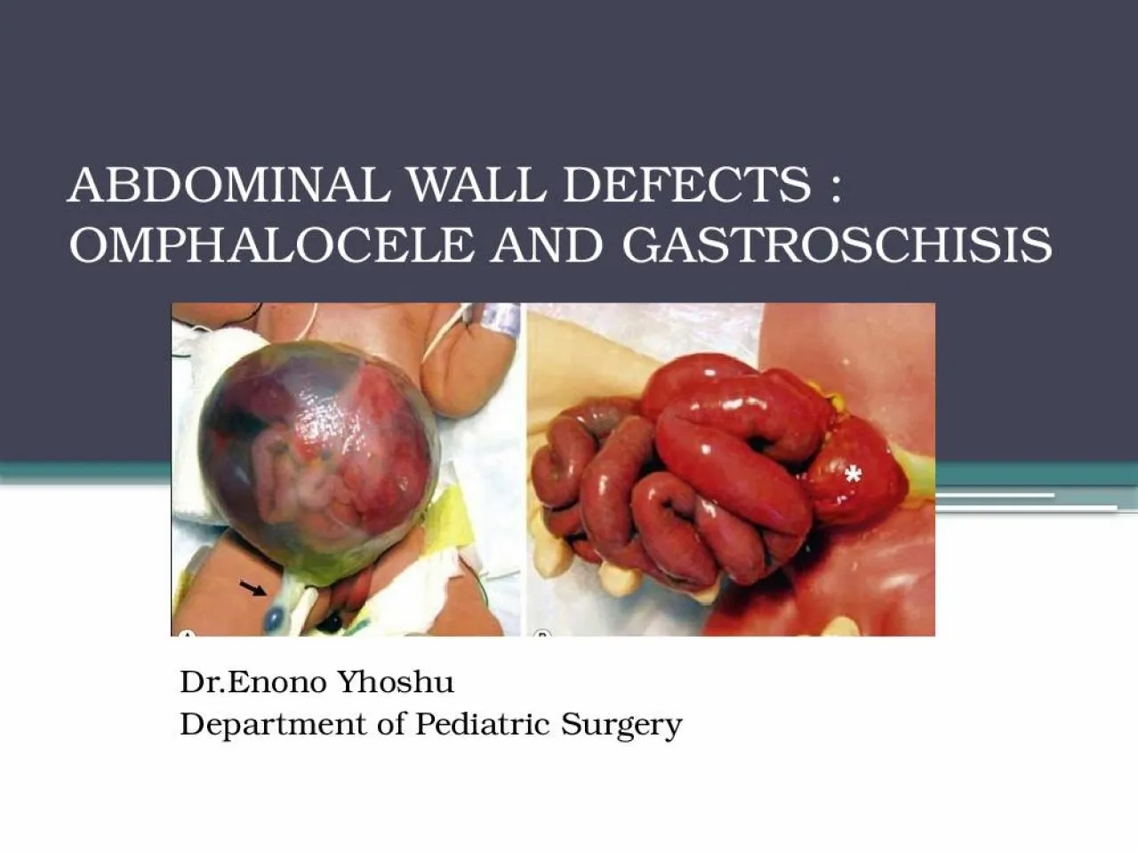 PPT-ABDOMINAL WALL DEFECTS : OMPHALOCELE AND GASTROSCHISIS