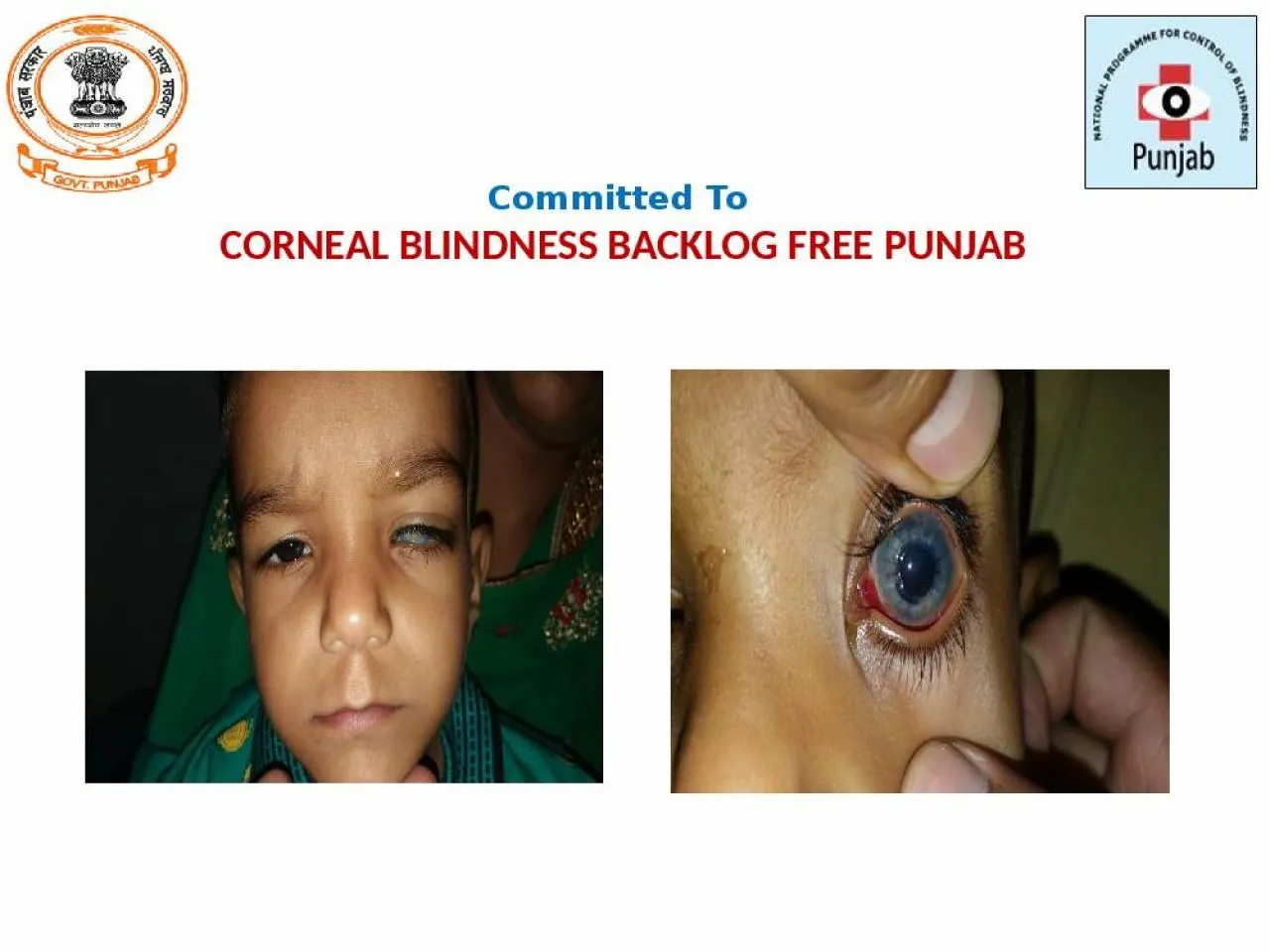 PPT-Committed To CORNEAL BLINDNESS BACKLOG