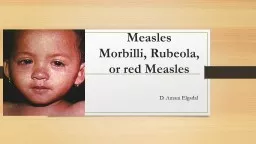 Measles  M orbilli, Rubeola, or red Measles