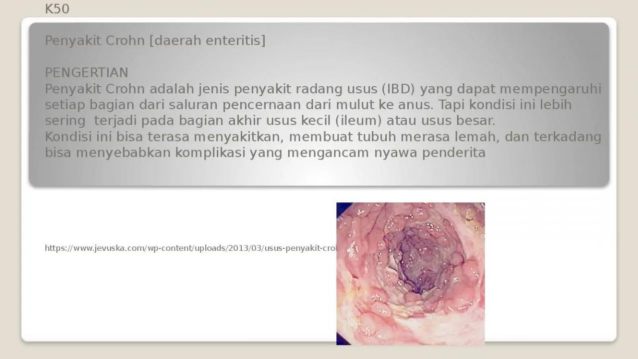 PPT-K50 Penyakit Crohn [daerah enteritis]