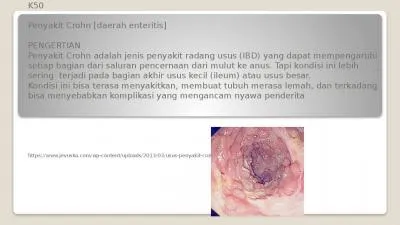 K50 Penyakit Crohn [daerah enteritis]