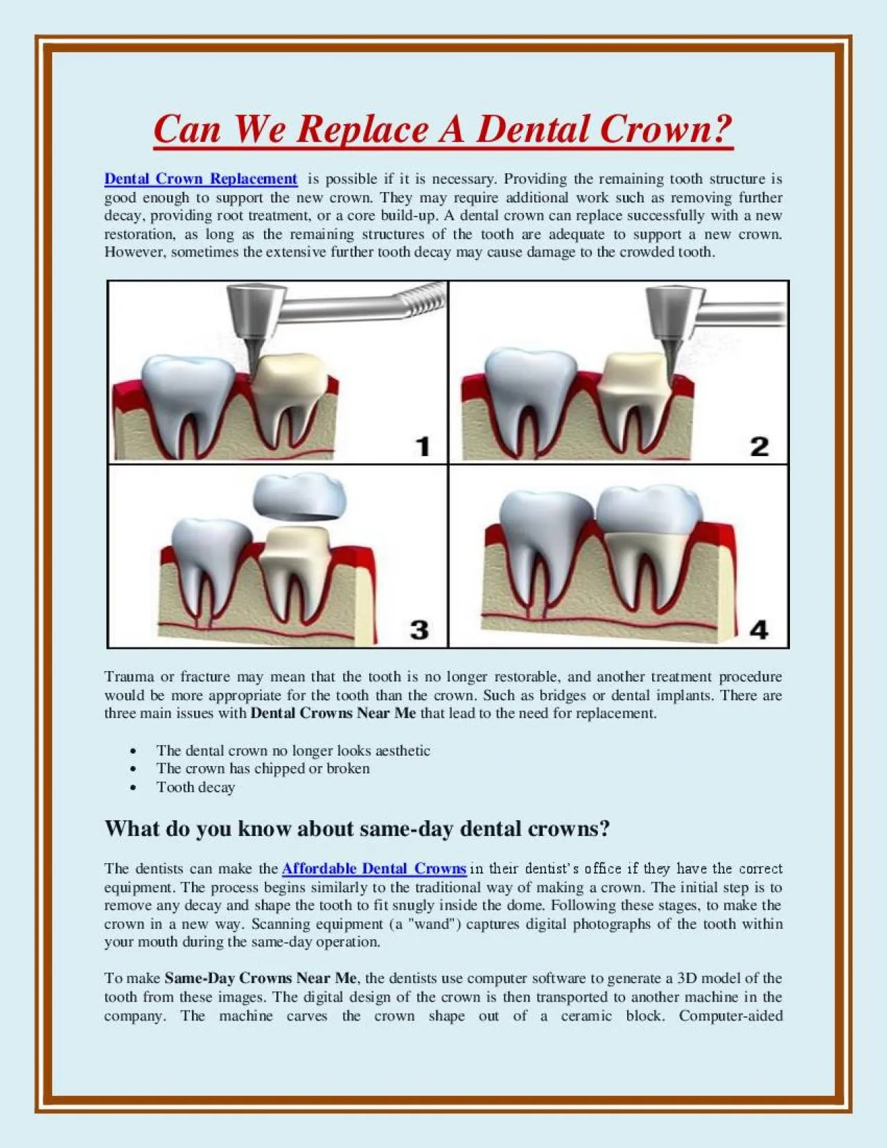 PDF-Can We Replace A Dental Crown?