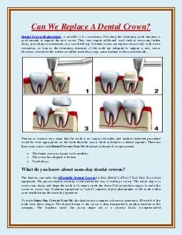 Can We Replace A Dental Crown?