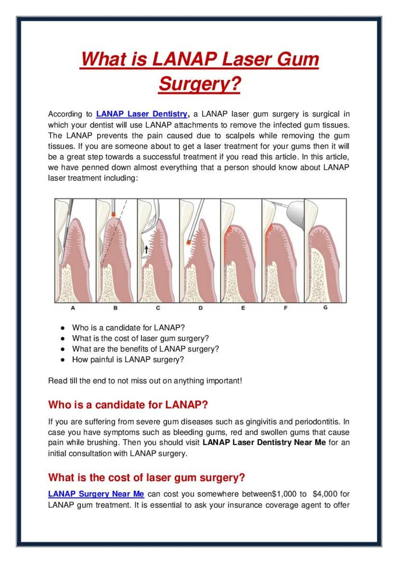 PDF-What is LANAP Laser Gum Surgery?